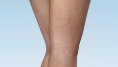 Sclerotherapy (vein treatment)
