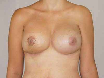 Breast reconstruction Before and after photos - Marbella Madrid - Ocean Clinic