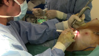 Aumento de pecho mamoplastia de aumento con implantes silicona Marbella Madrid