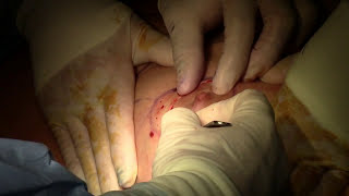 Cirugía de mamas cambio de implantes (prótesis) mamarios y lipoescultura Marbella Madrid