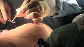 Breast reduction reduction mammoplasty Hall-Findlay technique with liposuction Marbella Madrid