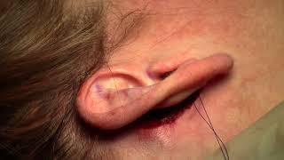 Ear correction bilateral otoplasty of protruding ears Marbella Madrid