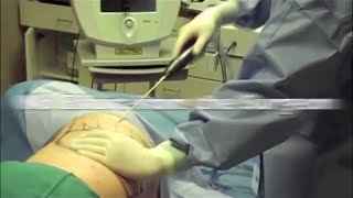 Liposuction Nutational Infrasonic Liposuclpture with the Lipomatic aspirator Marbella Madrid