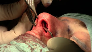 Cirugía de la nariz rinoplastia cerrada en la técnica del delivery Marbella Madrid
