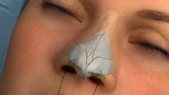 Nasenkorrektur (Rhinoplastik)