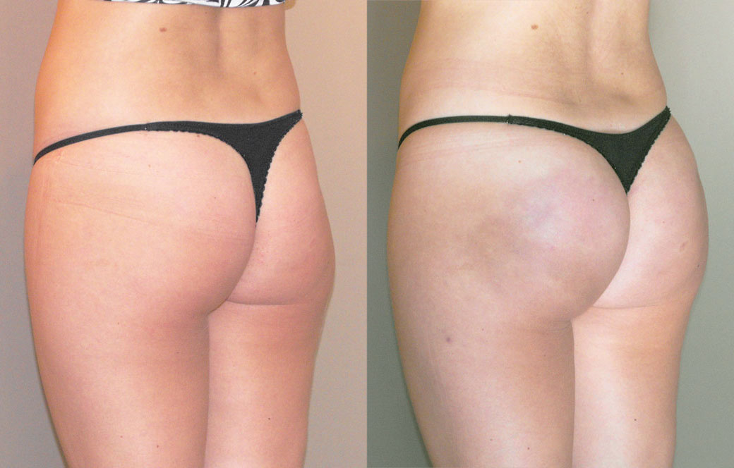 Buttock augmentation Before & after 01 | Ocean Clinic Marbella