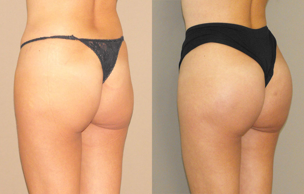 Buttock augmentation Before & after 02 | Ocean Clinic Marbella
