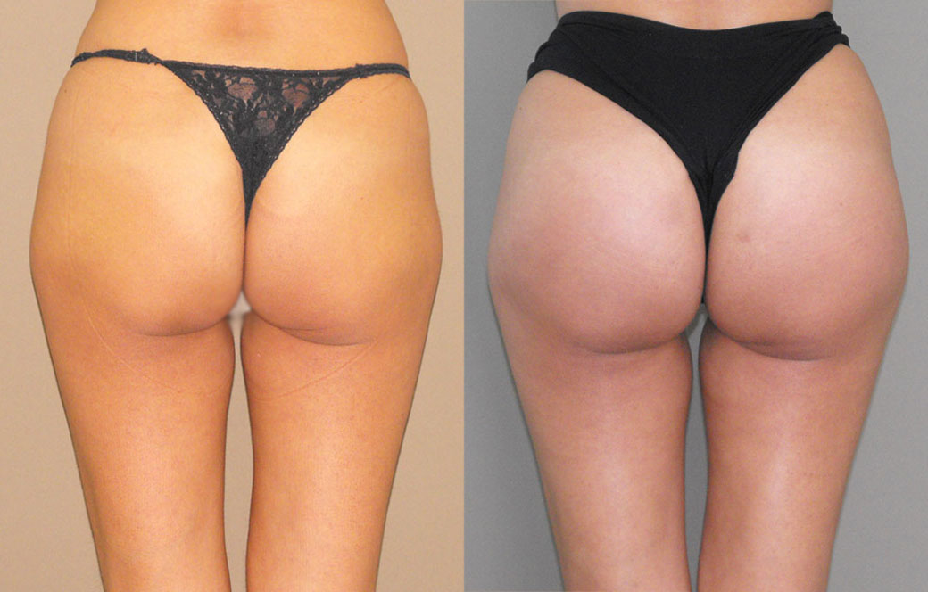 Buttock augmentation Before & after 03 | Ocean Clinic Marbella