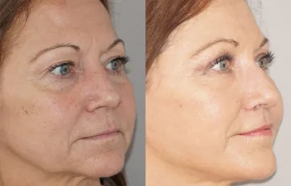 Before & After Gallery Autologous Fat Transfer 01 | Ocean Clinic Marbella