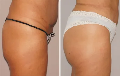 Before & After Gallery Autologous Fat Transfer 02 | Ocean Clinic Marbella