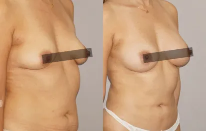 Before & After Gallery Autologous Fat Transfer 03 | Ocean Clinic Marbella