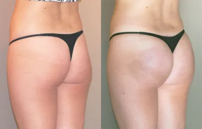 Before & After Gallery Brazilian Butt Lift (BBL) 01 | Ocean Clinic Marbella