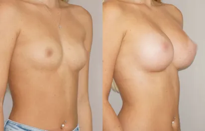 Resultados reales aumento de pecho en Marbella con implantes Motiva