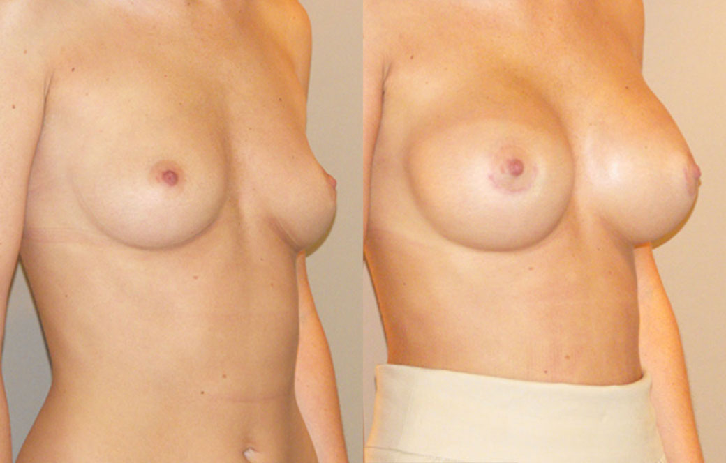 Brustvergrößerung mit Implantaten Vorher und Nachher 01 | Ocean Clinic Marbella