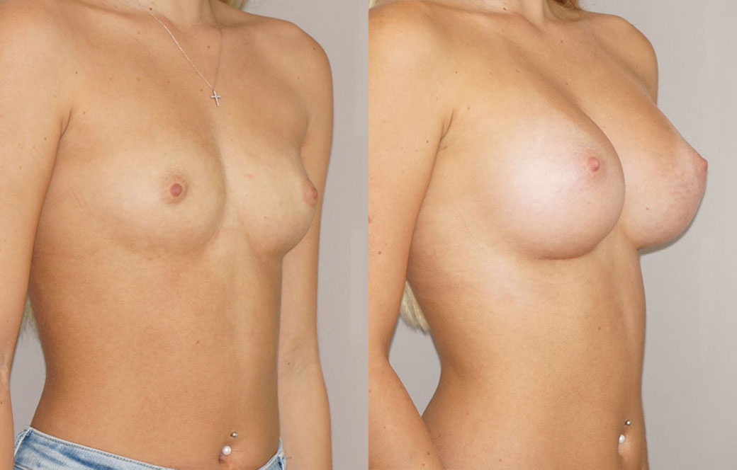 Breast Augmentation with Implants Before & after 03 | Ocean Clinic Marbella