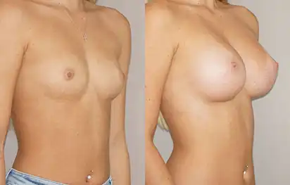 Before & After Gallery Silikon Breast Implants 03 | Ocean Clinic Marbella
