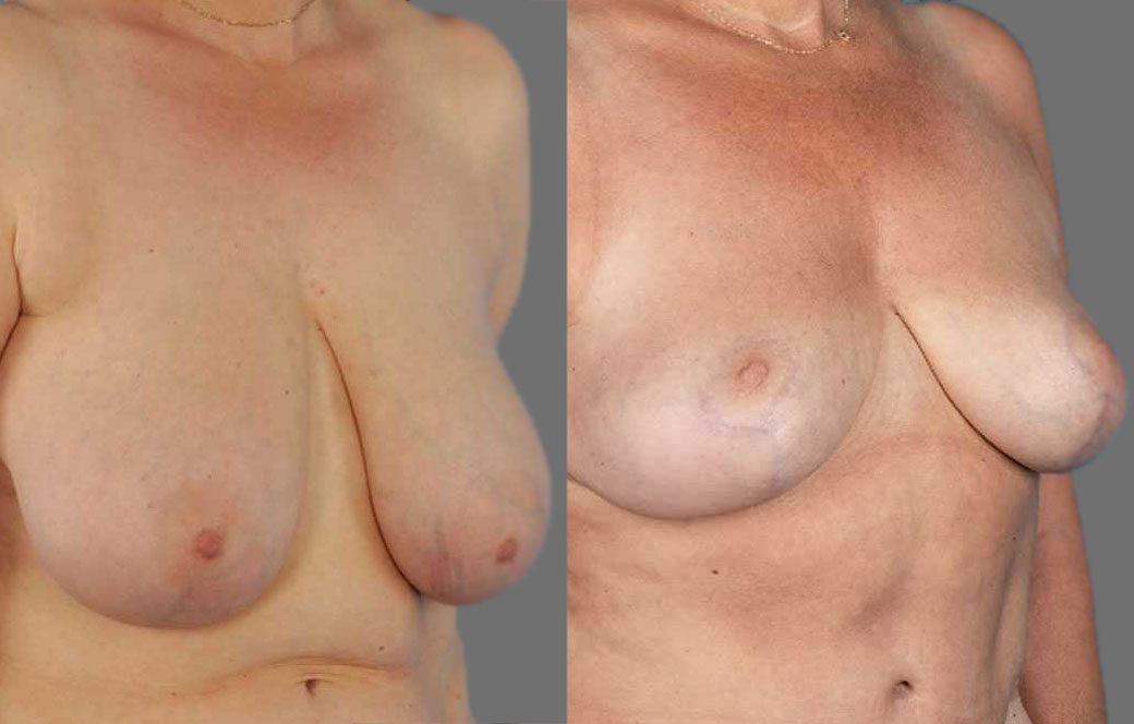 Breast reduction Before & after 01 | Ocean Clinic Marbella