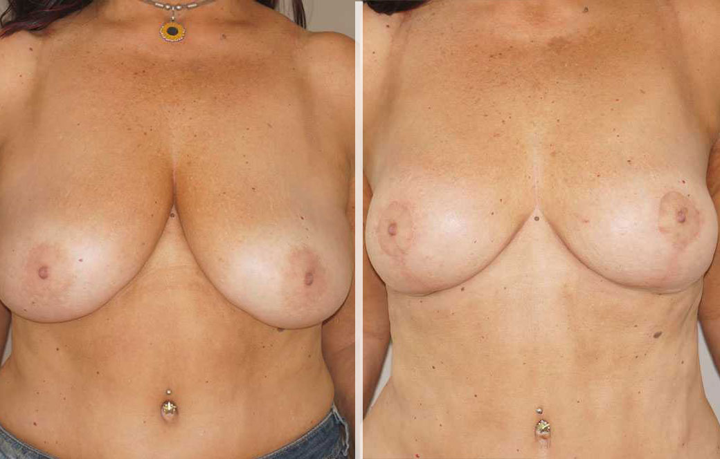 Breast reduction Before & after 02 | Ocean Clinic Marbella