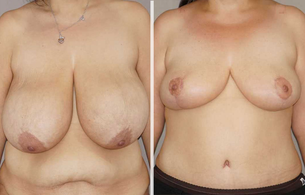 Breast reduction Before & after 03 | Ocean Clinic Marbella