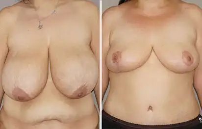 Before & After Gallery Breast Reduction 03 | Ocean Clinic Marbella