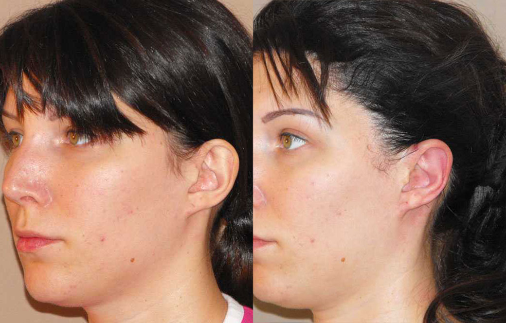 Cirugía de las orejas surgery Antes y después 01 | Ocean Clinic Marbella