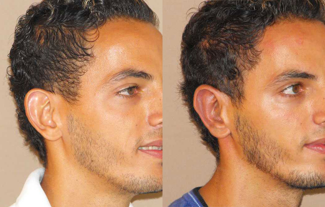 Cirugía de las orejas surgery Antes y después 02 | Ocean Clinic Marbella