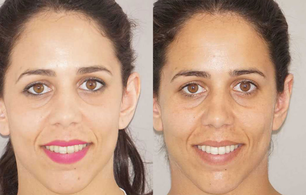 Cirugía de las orejas surgery Antes y después 03 | Ocean Clinic Marbella