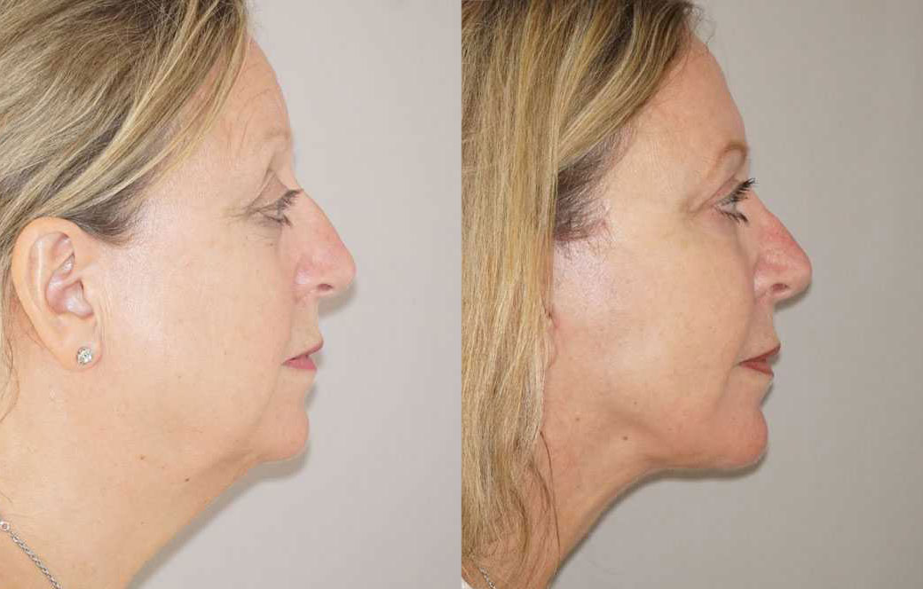 Eyelid lift Before & after 01 | Ocean Clinic Marbella