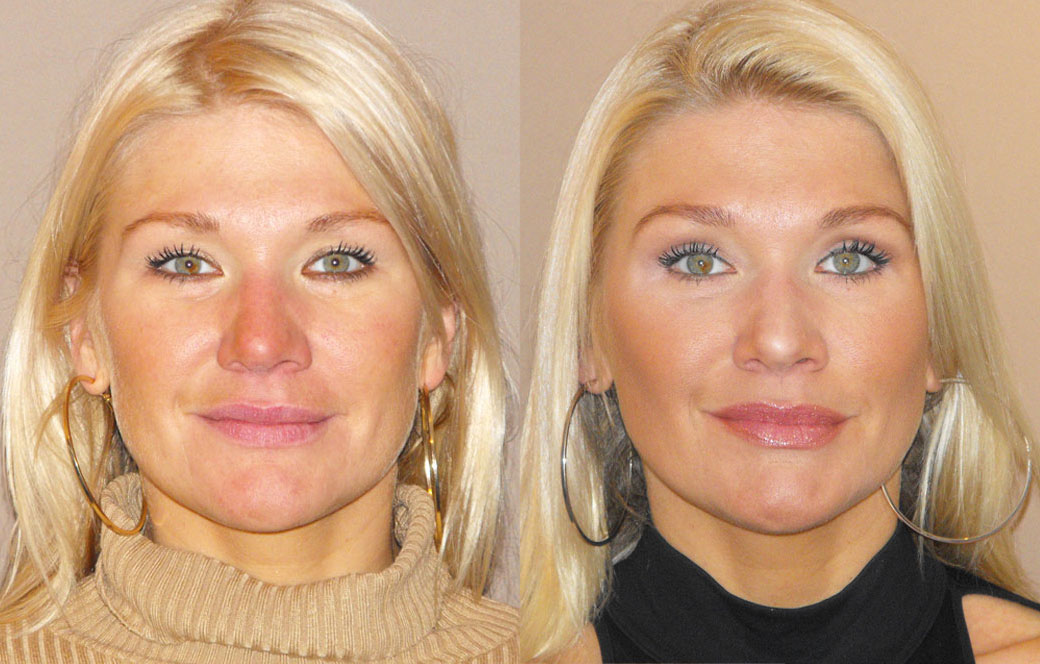 Eyelid lift Before & after 01 | Ocean Clinic Marbella