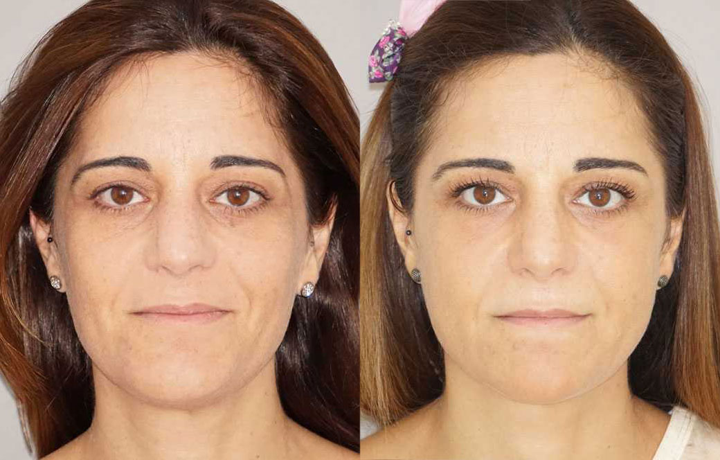 Cirugía de párpados Antes y después 02 | Ocean Clinic Marbella