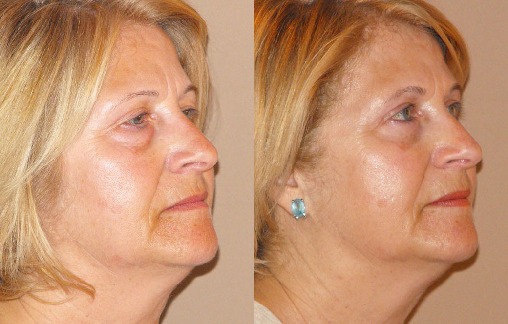 Eyelid lift Before & after 02 | Ocean Clinic Marbella