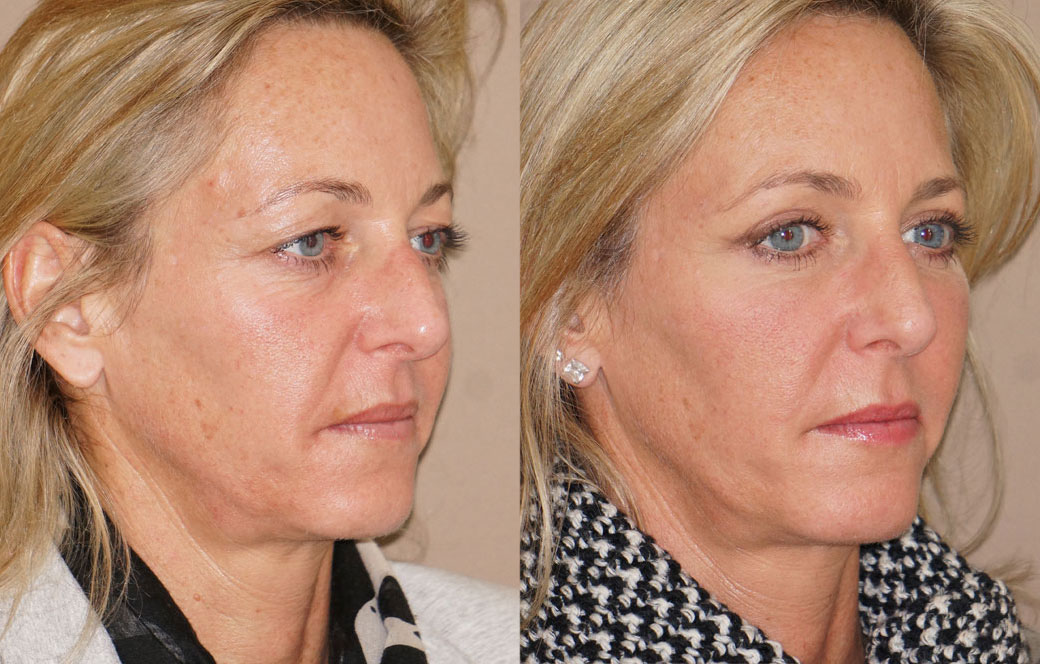 Eyelid lift Before & after 03 | Ocean Clinic Marbella