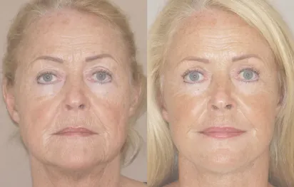 Facelift & Necklift