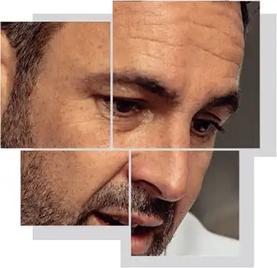 Benefits of Facelift & Necklift | Ocean Clinic Marbella