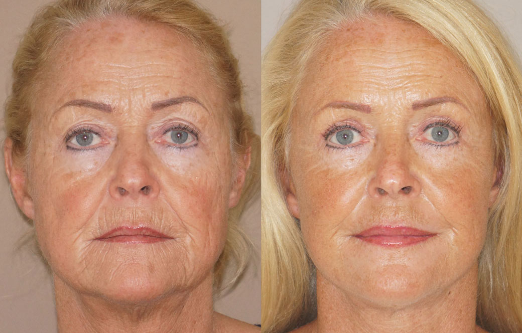 Lifting facial & lifting de cuello Antes y después 04 | Ocean Clinic Marbella