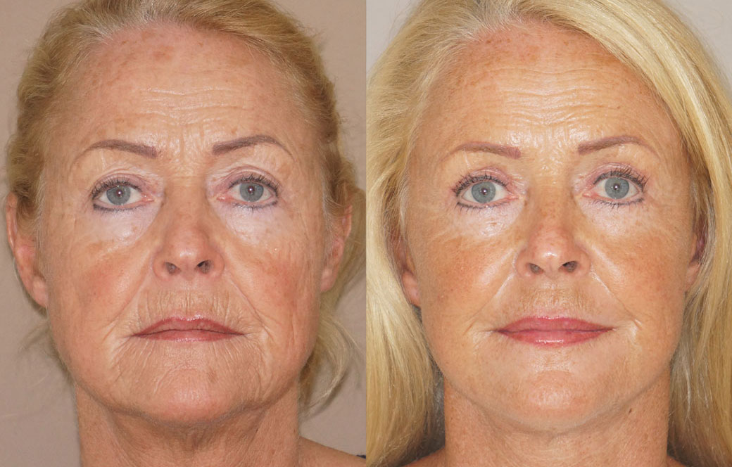 Facelift & Neck Lift Before & after 01 | Ocean Clinic Marbella