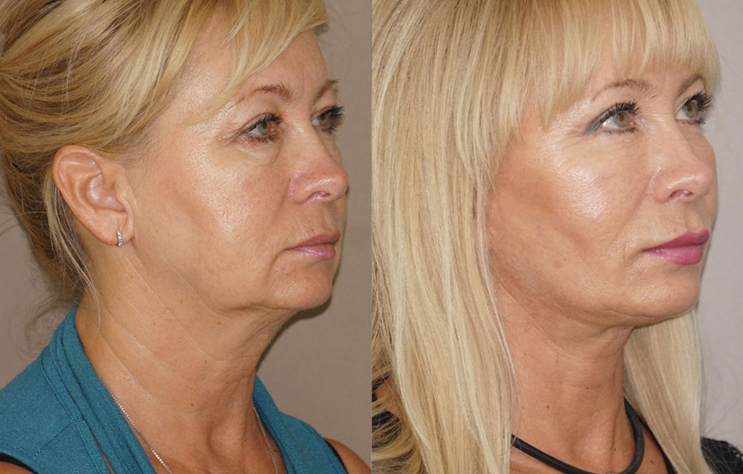 Lifting facial & lifting de cuello Antes y después 02 | Ocean Clinic Marbella