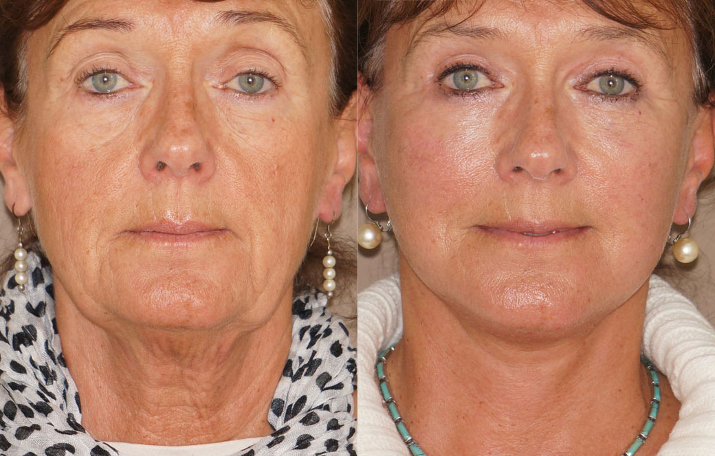 Facelift & Neck Lift Before & after 03 | Ocean Clinic Marbella