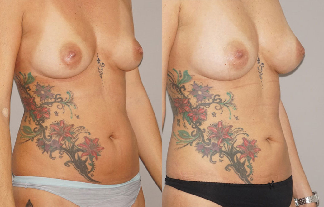 Brustvergrößerung mit Eigenfett Vorher und Nachher 02 | Ocean Clinic Marbella