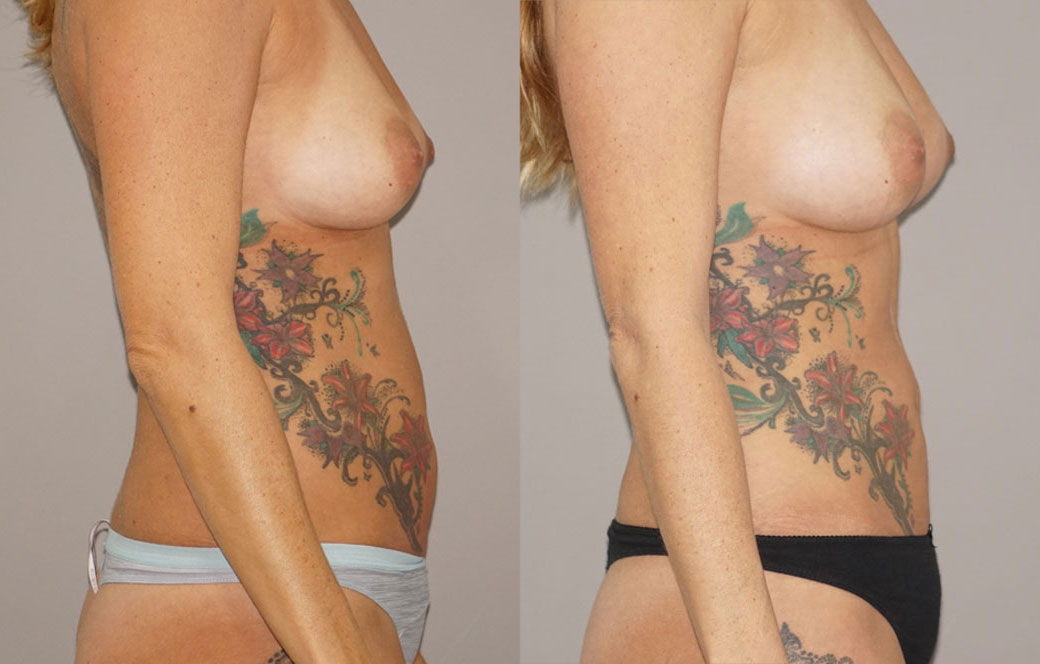 Fat transfer breast augmentation Before & after 03 | Ocean Clinic Marbella