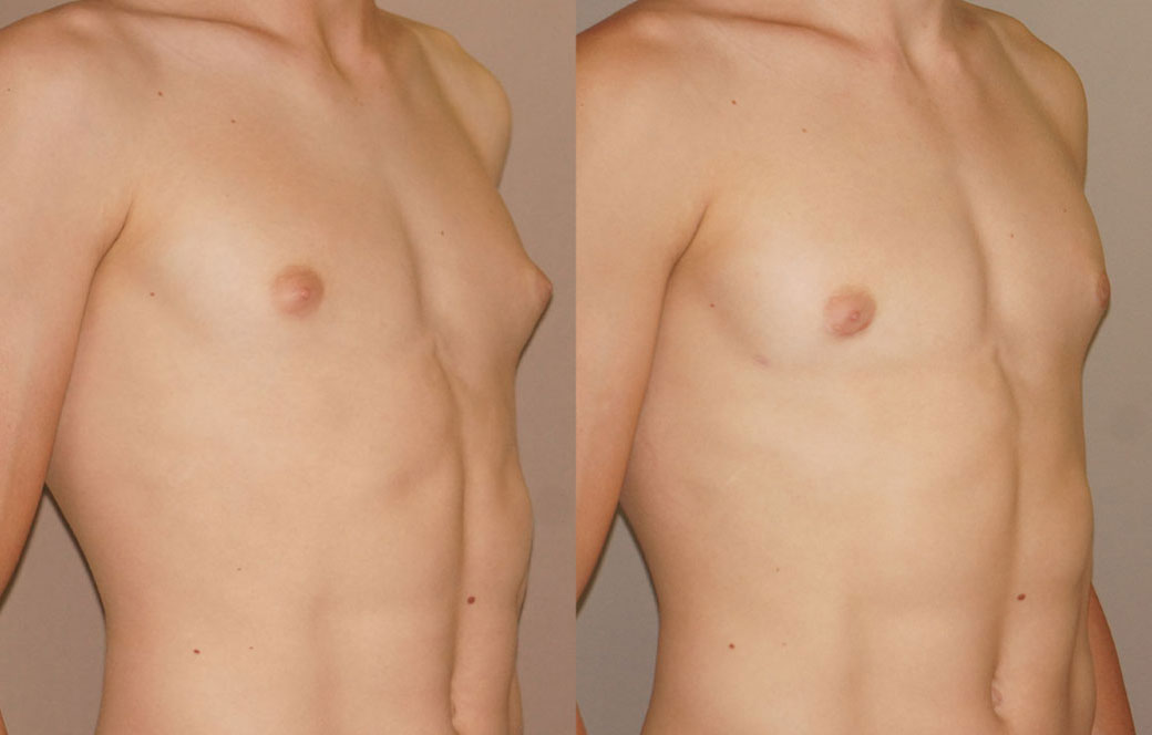 Surgical Correction of Gynecomastia Before & after 01 | Ocean Clinic Marbella
