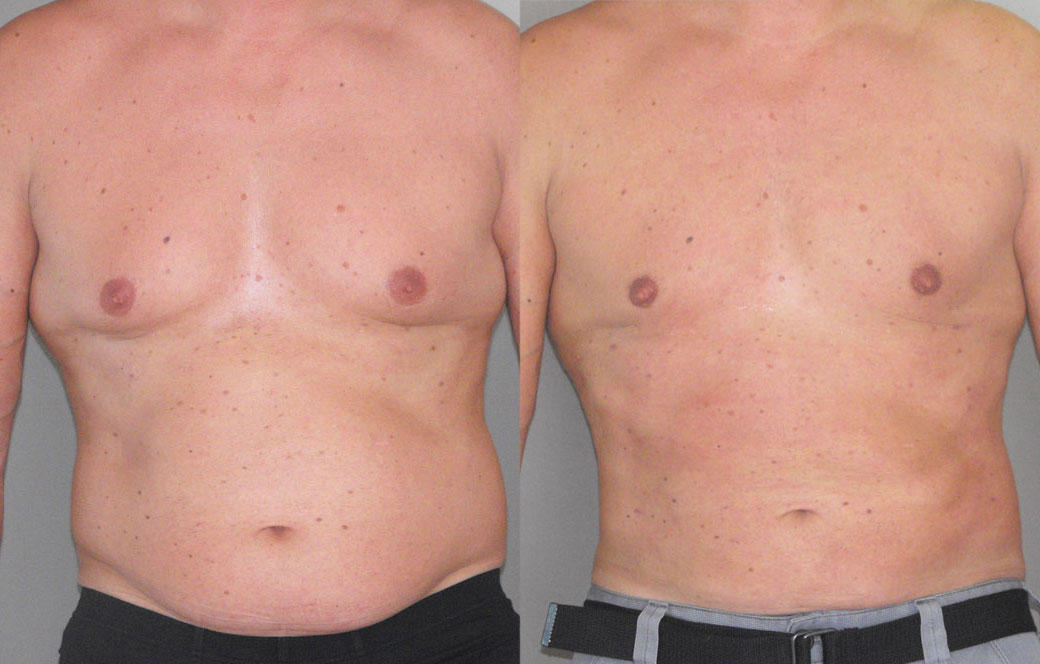 Surgical Correction of Gynecomastia Before & after 02 | Ocean Clinic Marbella