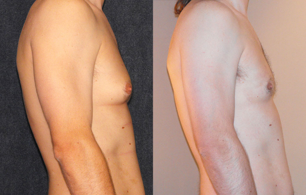 Surgical Correction of Gynecomastia Before & after 03 | Ocean Clinic Marbella