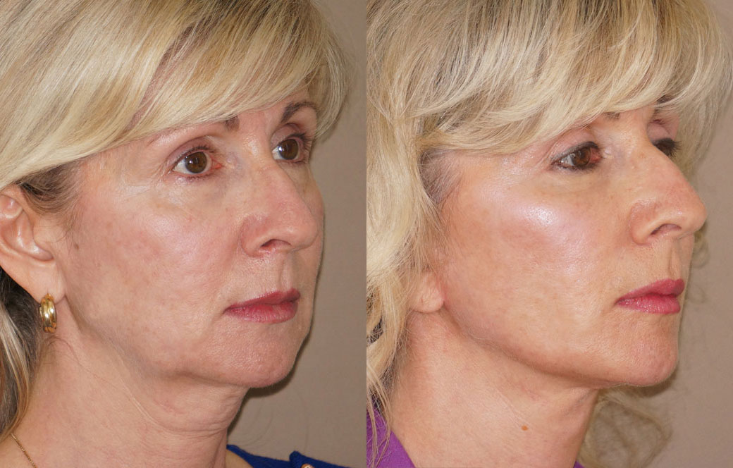 Lipofilling facial Antes y después 04 | Ocean Clinic Marbella