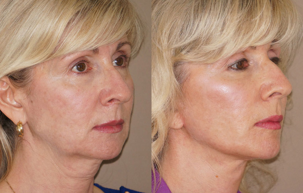 Lipofilling facial Antes y después 01 | Ocean Clinic Marbella