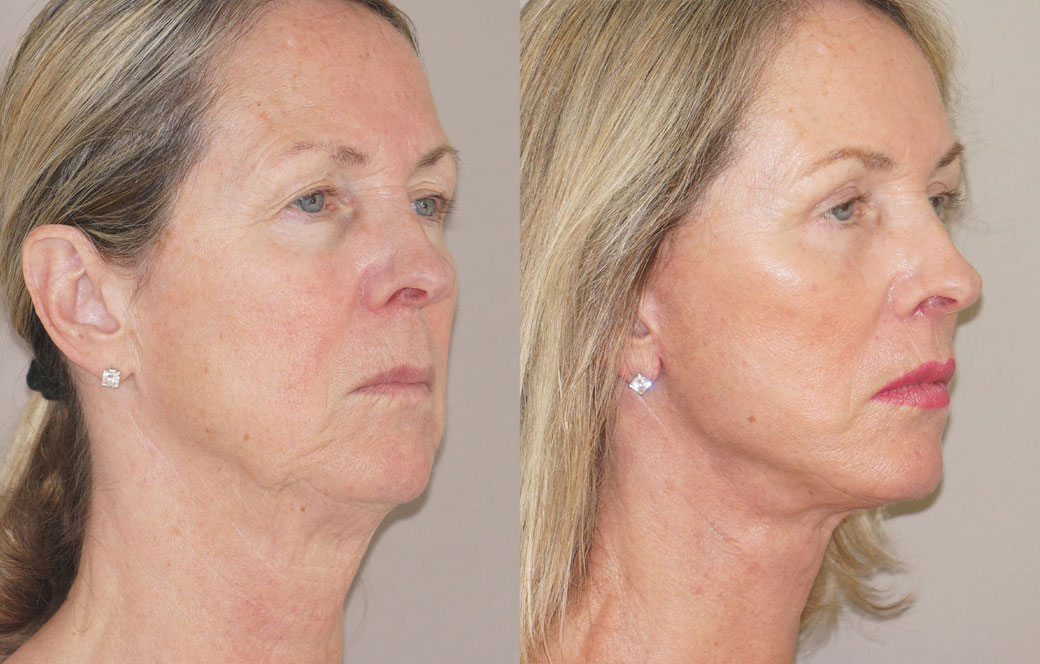 Lipofilling facial Antes y después 05 | Ocean Clinic Marbella