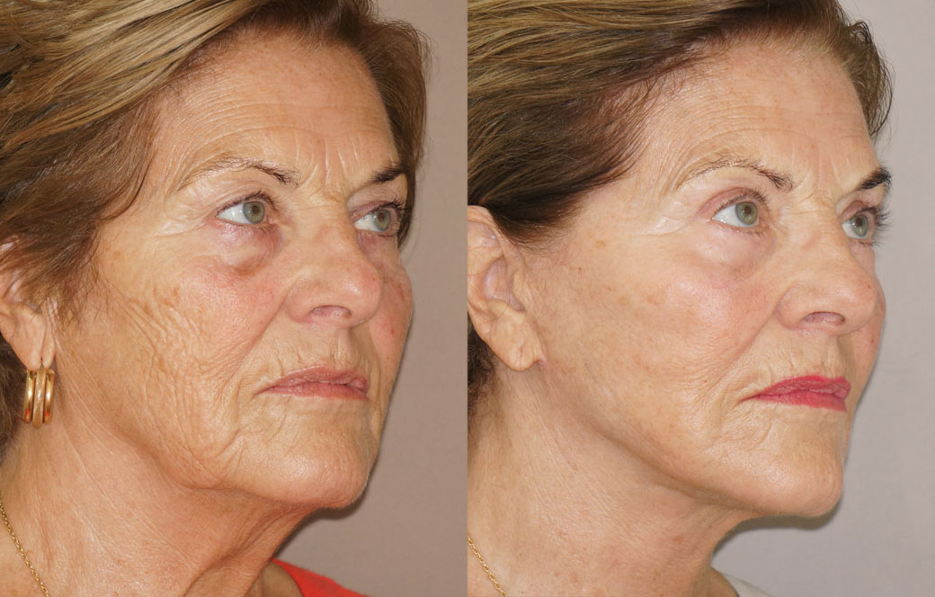 Lipofilling facial Antes y después 03 | Ocean Clinic Marbella