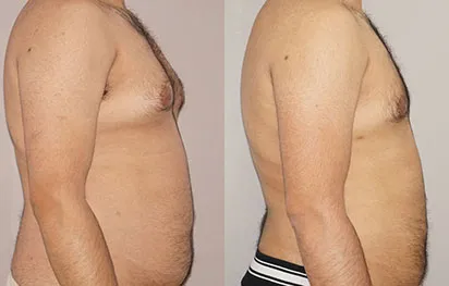 Resultados reales Liposucción en Marbella