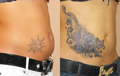 Liposucción con grasa propia antes y después en Marbella