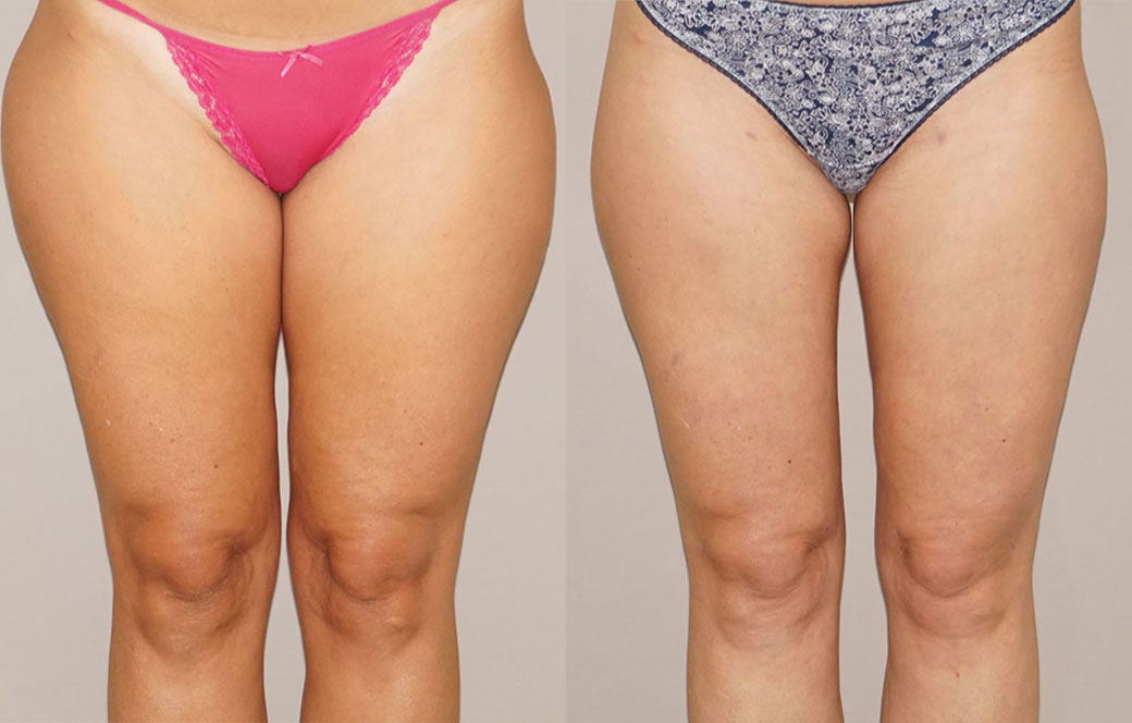 Liposuction and Liposculpture Before & after 01 | Ocean Clinic Marbella